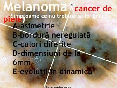 articol-despre-melanoma-simptome