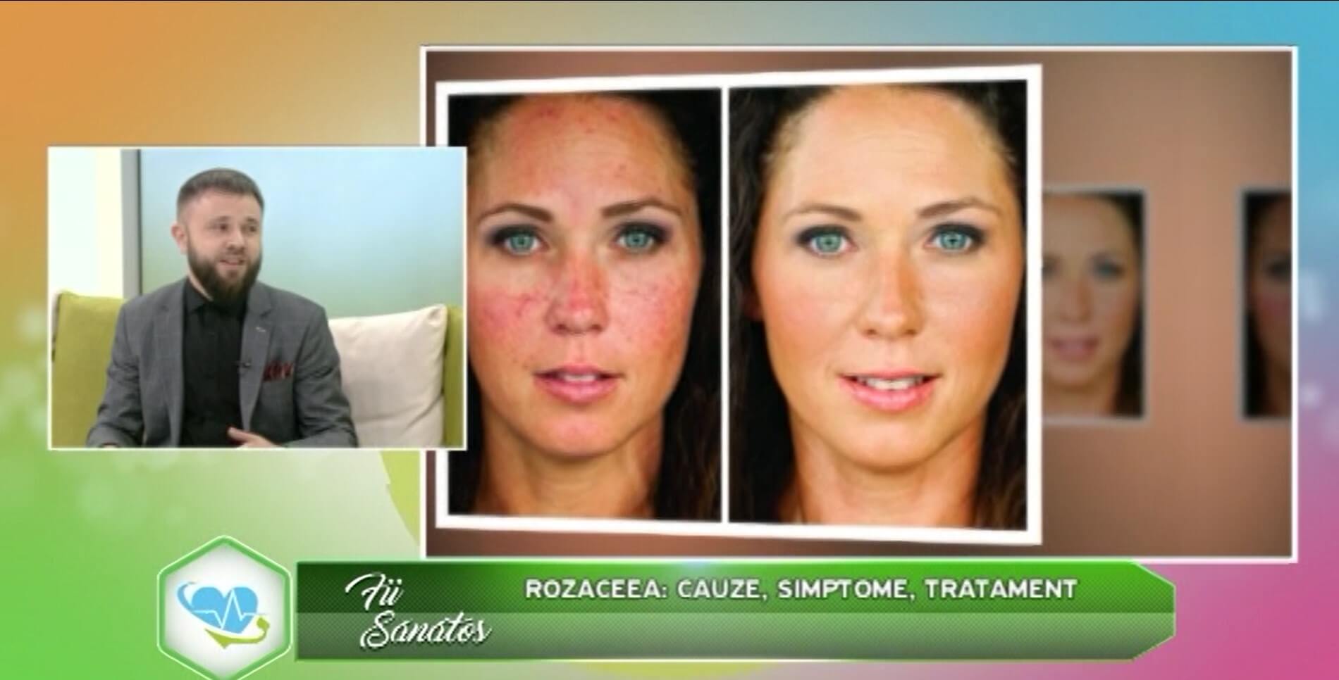 articol-rozace-pasii-lecuirea-altermed