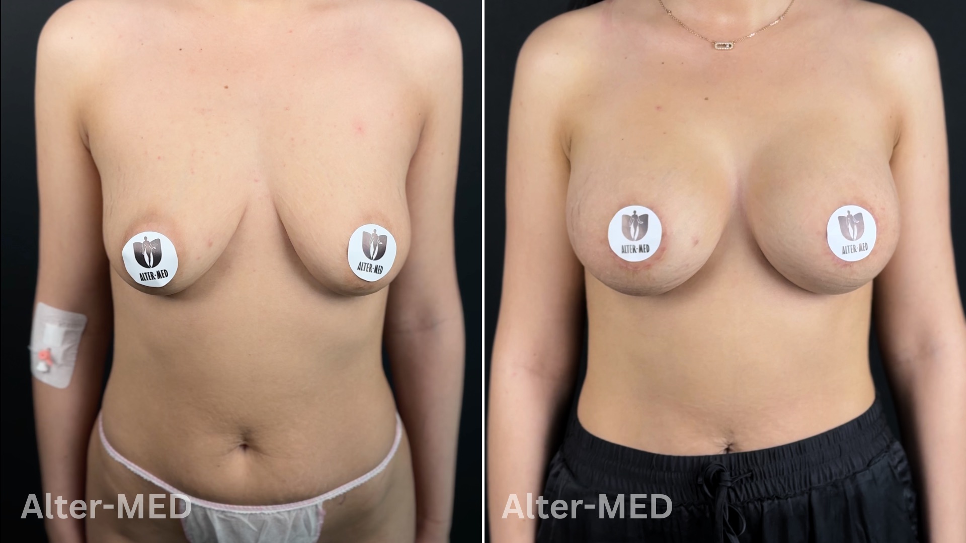 Augmentare Mamara 10
