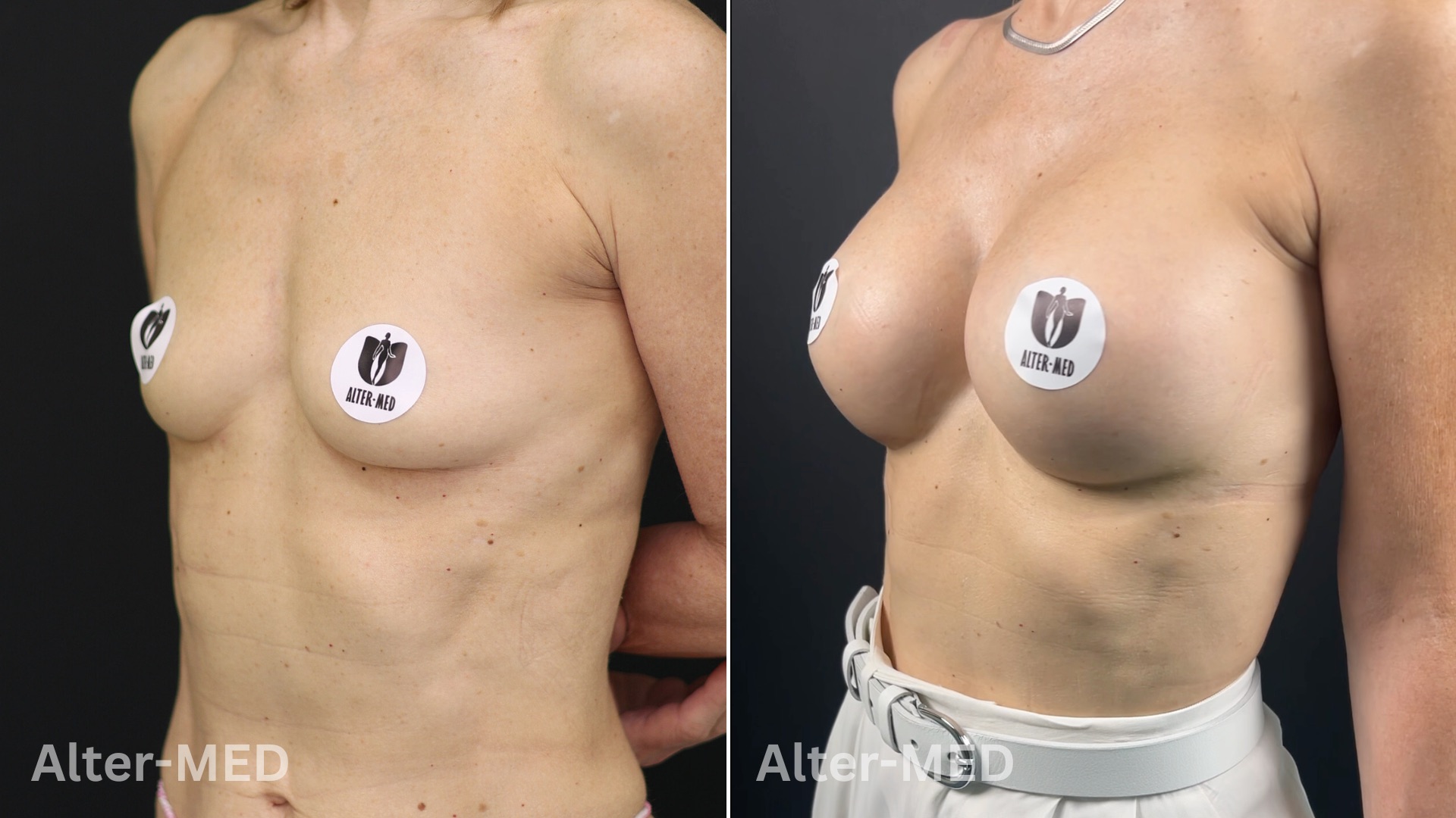 Augmentare Mamara 11