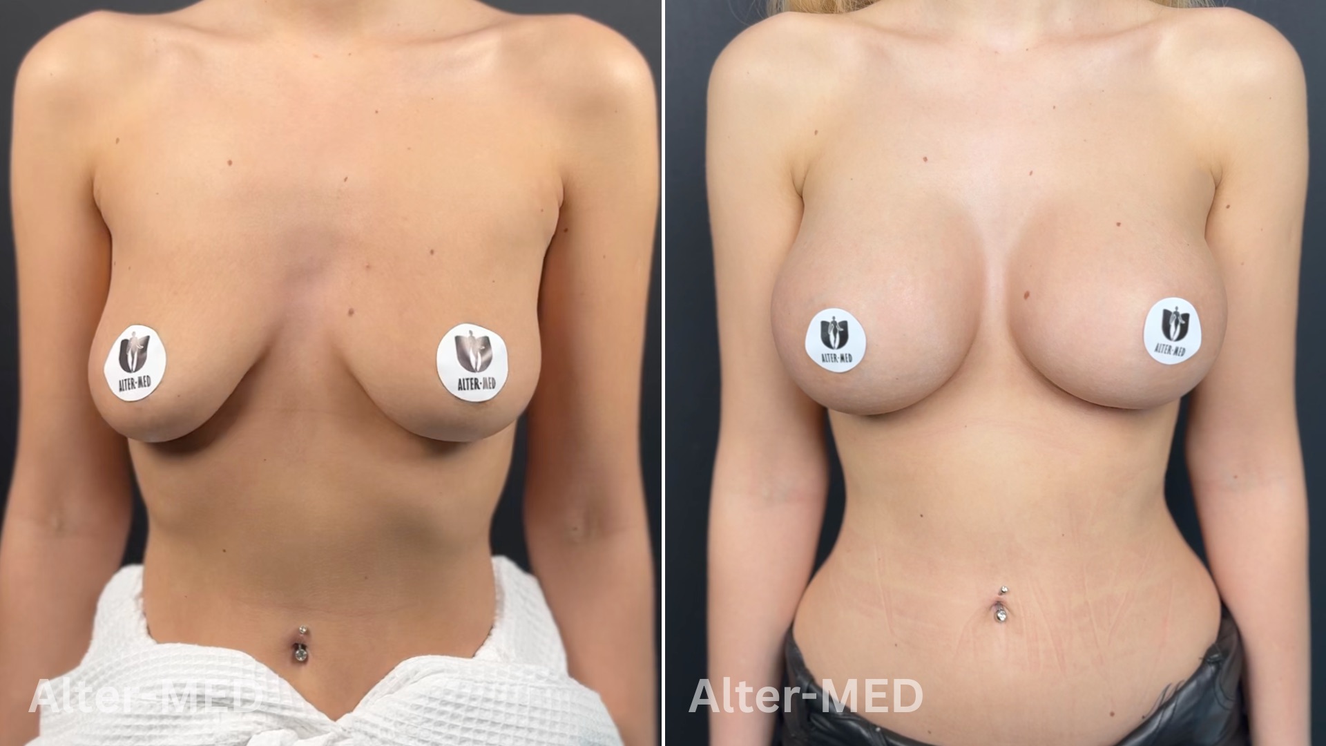 Augmentare Mamara 9