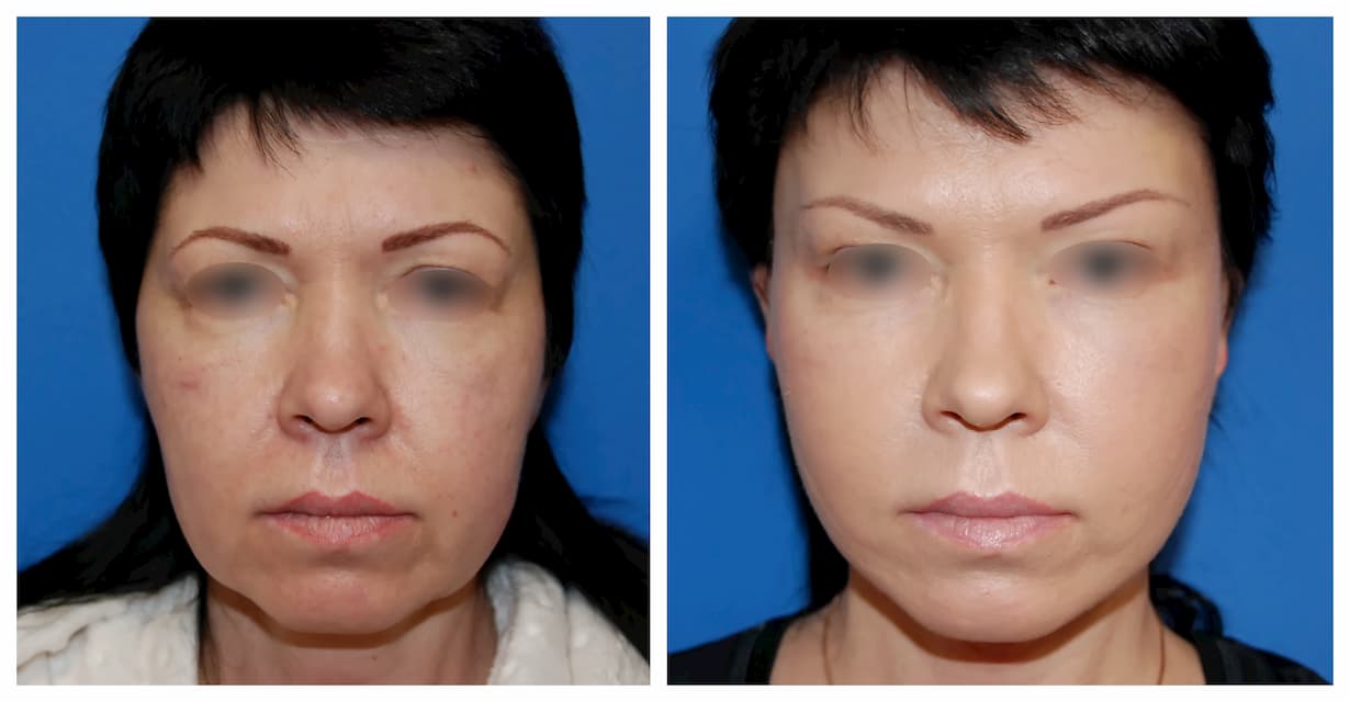 ridurile faciale nazolabiale cum se elimina retete de ingrijire corporala