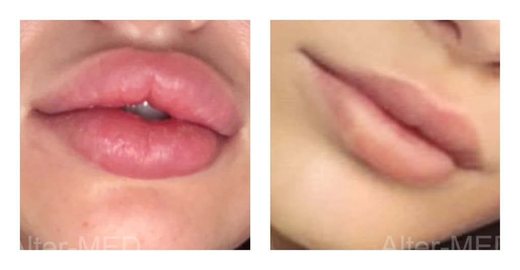 Lips 3
