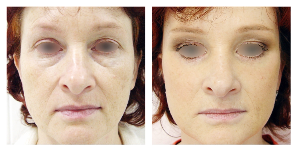 Intinerire Faciala Laser CO2 Fractionat
