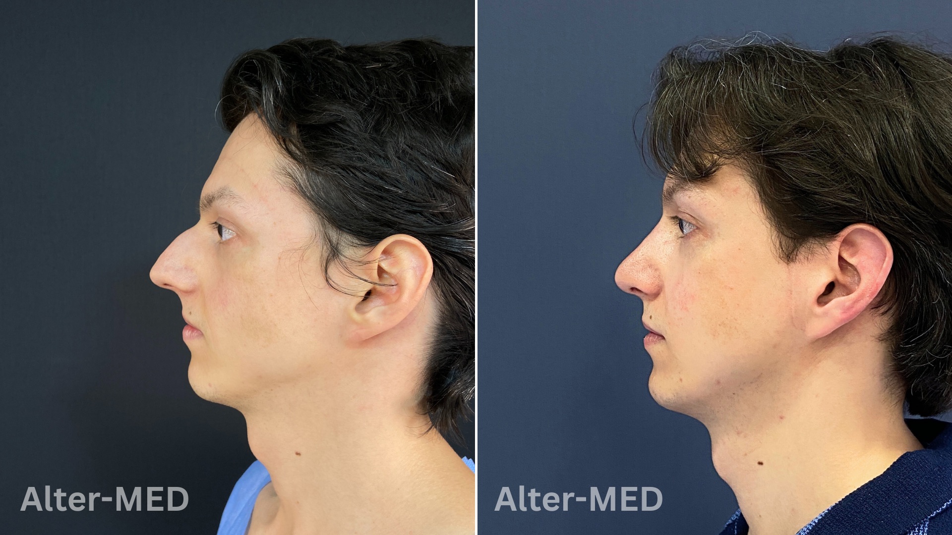  Rinoplastie 28