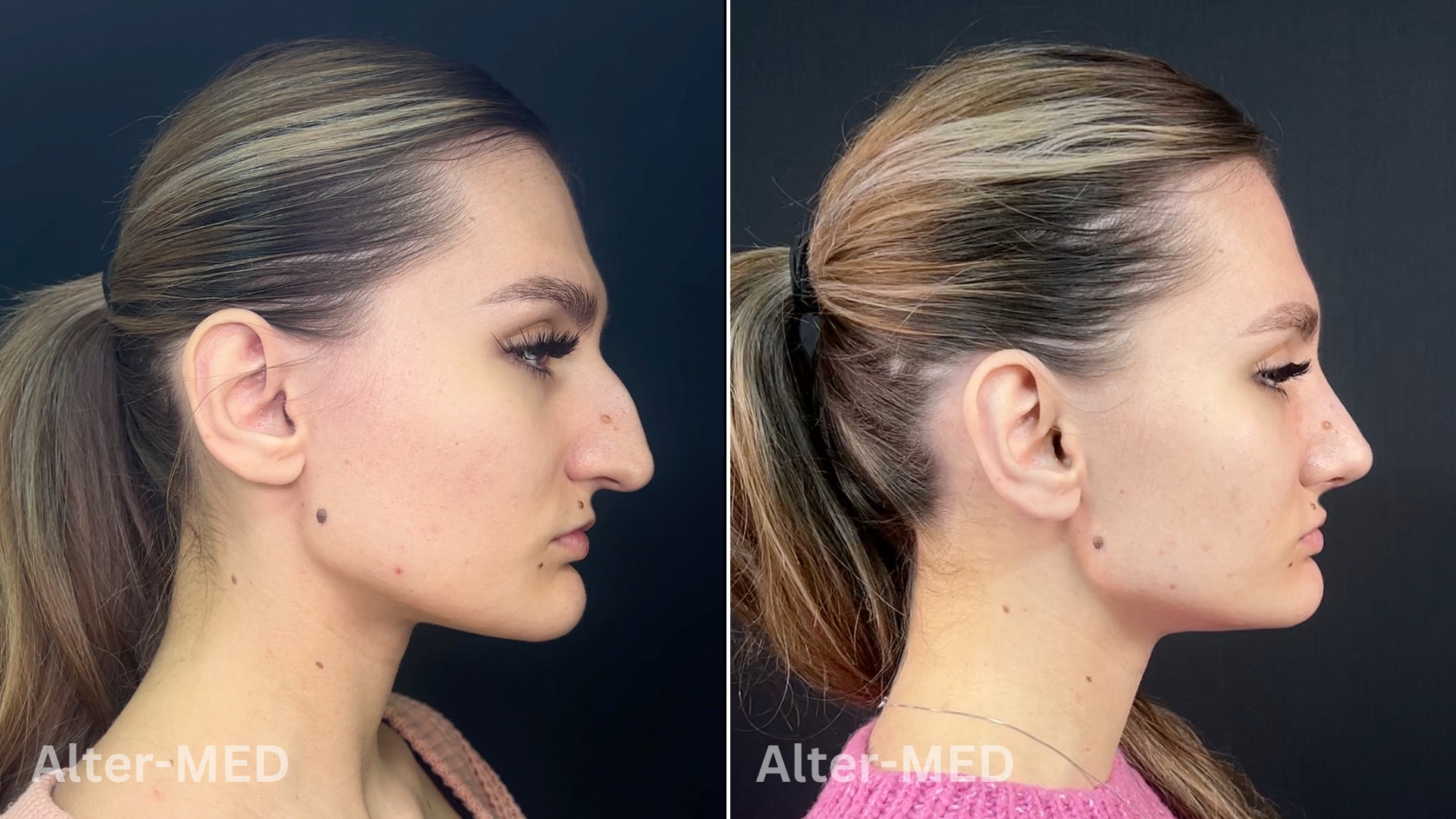  Rinoplastie 33
