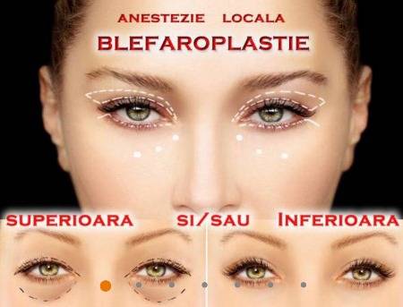 blefaropastia Blepharoplasty (plastic reconstruction of eyelids) - Clinica de Medicină Estetică și Chirurgie Plastică