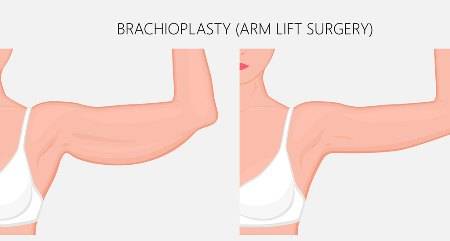 branhioplastie Бранхиопластика - удаления жира и кожи рук | Alter-MED
