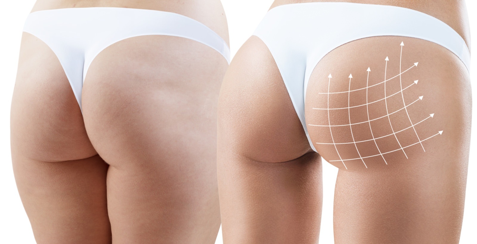 Brazilian Butt Lift - Clinica de Medicină Estetică și Chirurgie Plastică