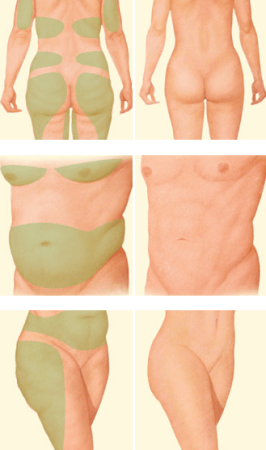 liposuctie Липосакция - избавьтесь от жировых отложений| Alter-MED