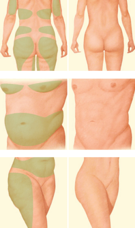 liposuctie Liposuction - Clinica de Medicină Estetică și Chirurgie Plastică