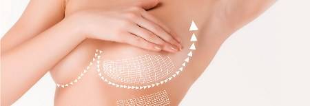 mastopexie Mastopexy (mammary lifting) - Clinica de Medicină Estetică și Chirurgie Plastică