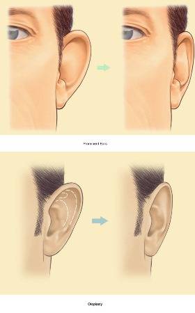 otoplastie Otoplasty (plastic reconstruction of ear) - Clinica de Medicină Estetică și Chirurgie Plastică