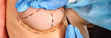 reductia_sinelor Breast reduction - Clinica de Medicină Estetică și Chirurgie Plastică
