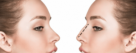 rinoplastia Ринопластика - эстетическая коррекция носа| Alter-MED