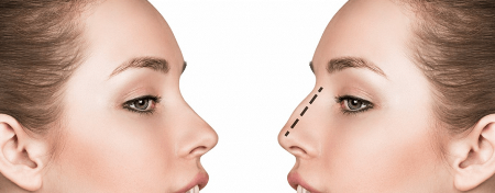 rinoplastia Rhinoplasty - Clinica de Medicină Estetică și Chirurgie Plastică