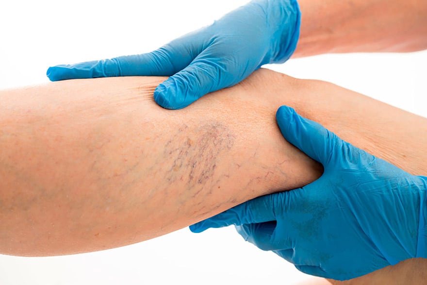 Tratamentul varicelor cu laser – fără durere și fără cicatrici